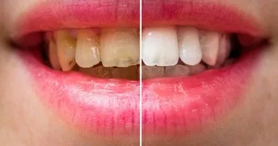 Bu yöntem sayesinde dişleriniz bembeyaz olacak! İşte dişleri beyazlatmanın doğal yolları
