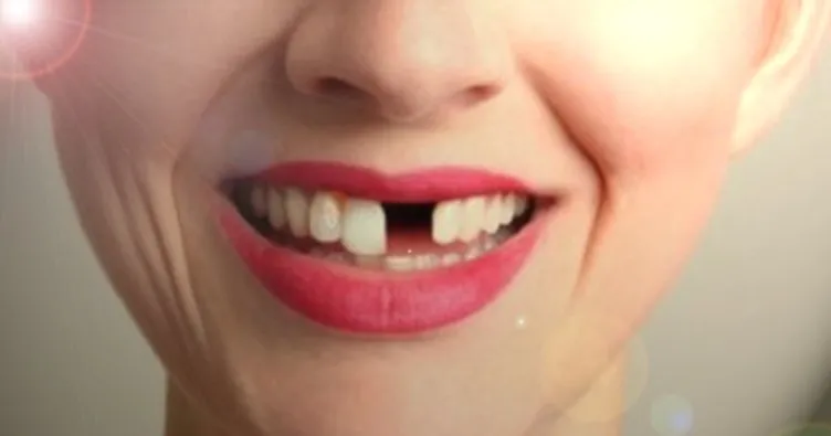Rüyada Diş Dökülmesi Ne Anlama Gelir? Rüyada Diş Dökülmesi, Diş Kırılması Görmenin Anlamı ve Tabiri