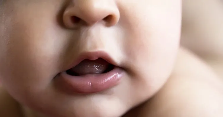 Bebeklerde dudak bağı sorunu nedir? Bebeklerde dudak bağı nasıl tedavi edilir?