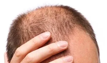 Saç dökülmesinin nedenleri nelerdir?