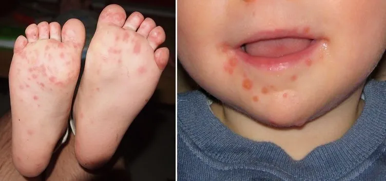 Çocuklarda el ayak ağız hastalığına dikkat
