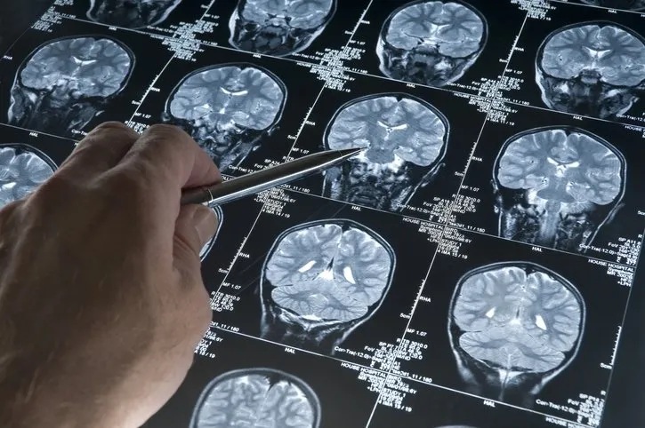 Alzheimer’ın en büyük 3 nedeni! Sinir bilimci beyni korumanın yöntemini anlattı...