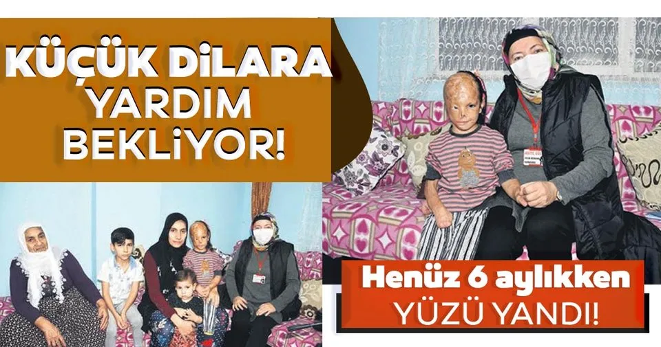 Yüzü yanan Dilara destek bekliyor Son Dakika Haberler