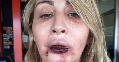 Dudağı çürüyünce şoka girdi! Prof. Dr. Ömer Özkan iyileştirdi!