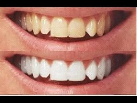 Zerdeçal ile doğal diş beyazlatma