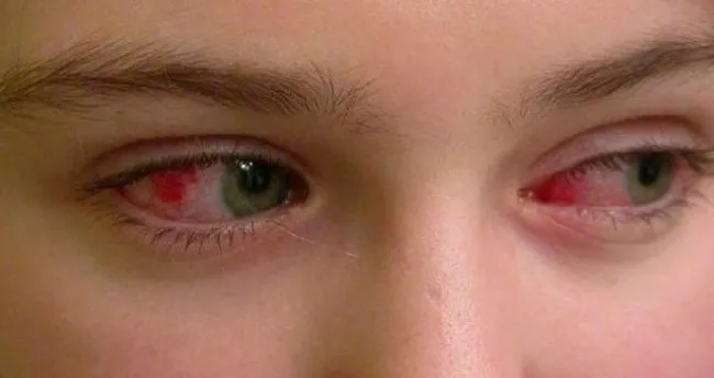 goz nezlesi belirtileri ve tedavi yontemleri goz nezlesi neden olur nasil gecer saglik haberleri