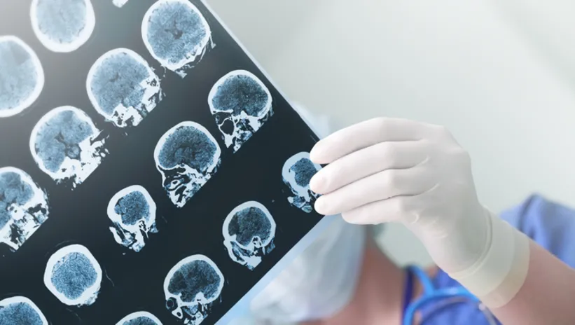 Uzman isim uyardı... Epilepsinin nedeni ne?