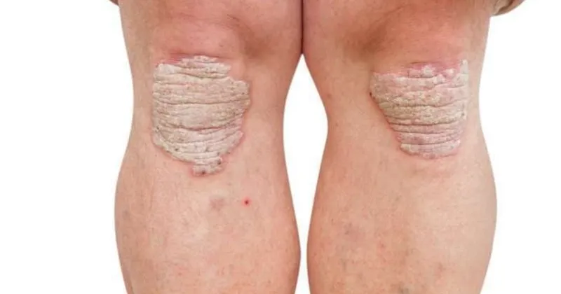 Sedef Hastaligi Nasil Gecer Sedef Hastaligi Nedir Saglik Haberleri