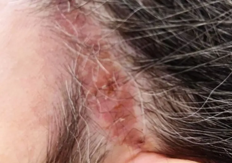 SON DAKİKA | Estetik ameliyatı genç kadının kabusu oldu: Kulağını kesip yüzünü diktiler