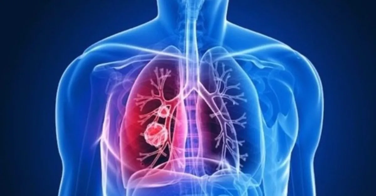 yetiskinlerde ve bebeklerde bronsite ne iyi gelir nasil gecer bronsite iyi gelen seyler evde dogal cozumler saglik haberleri