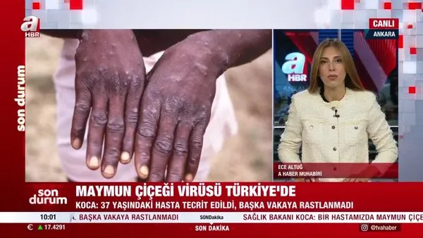 SON DAKİKA: Maymun Çiçeği Hastalığı Türkiye'de görüldü! Bakan Koca'dan açıklama | Video