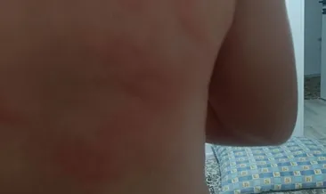 Elazığ’da korkutan olay | Heryeri şişti hastanelik oldu: Sebebi şoke etti!