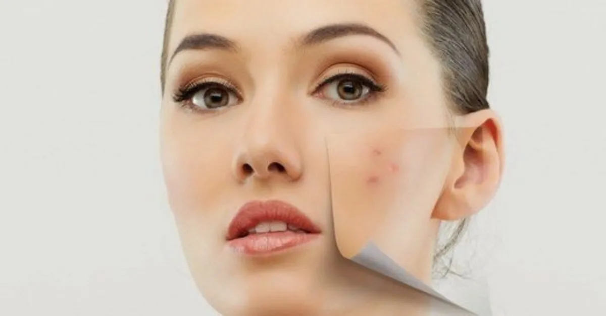 yuzdeki sivilce izleri nasil gecer