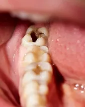 Diş çürüğünü yok eden süper besinler