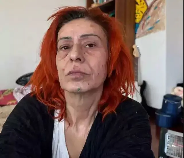 Yıldız Tilbe’nin yüzü yandı! Korkutan görüntüyü sosyal medyasında paylaştı: Geçer inşallah