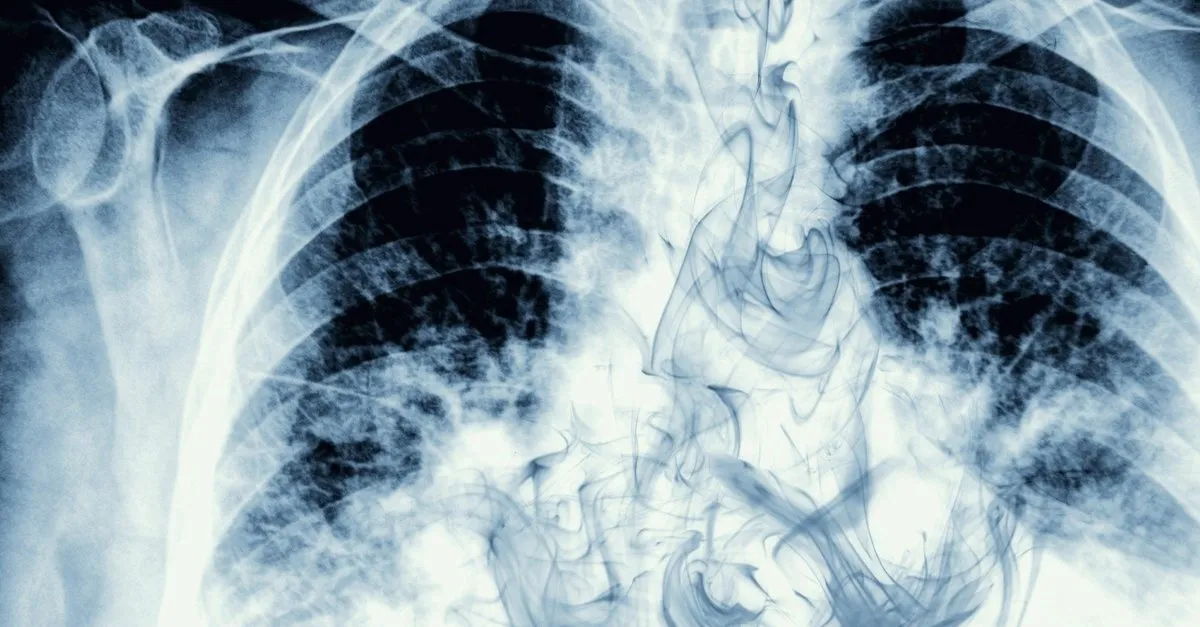 akciger kanseri belirtileri nelerdir