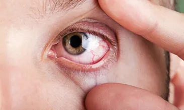 Bu hava sıcaklıklarına dikkat! Gözlerde büyük hasarın sebebi