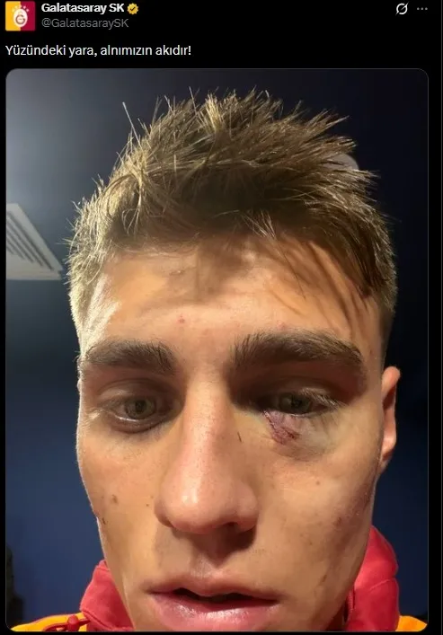 galatasaraydan-kazimcan-karatas-paylasimi-yuzundeki-yara-alnimizin-akidir-1764623085324.jpeg