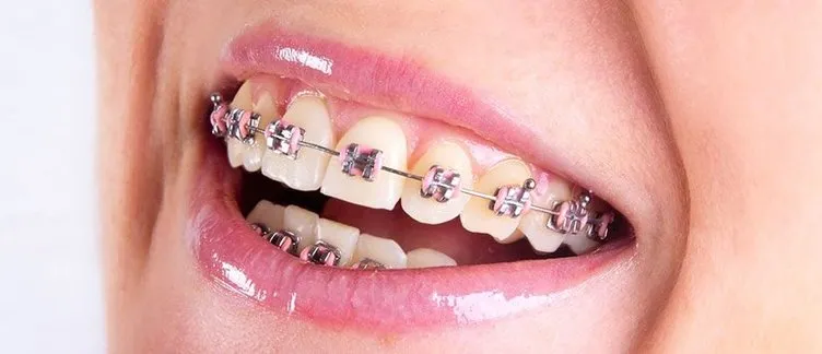 Diş teli tedavisi ile ilgili doğru bilinen 5 yanlış