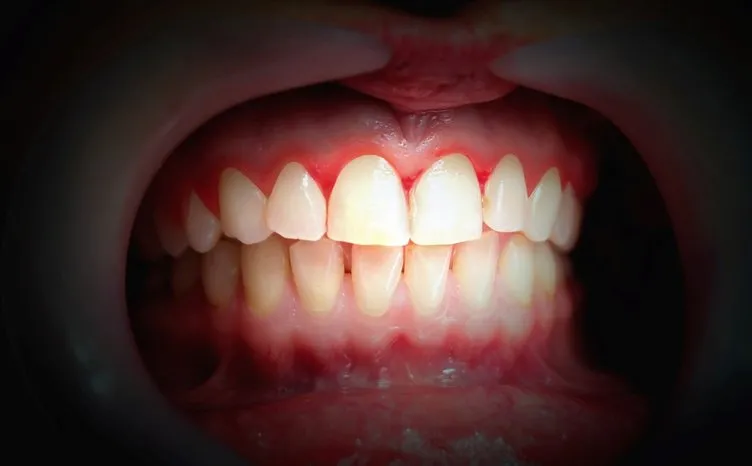 Diş Etleriniz ile Eklemlerinizin Sağlığı Birbirine Bağlı Olabilir!