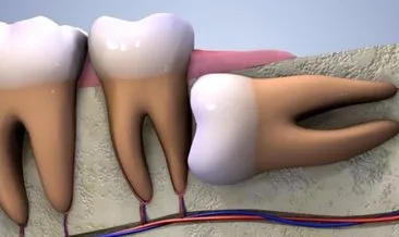 20’lik diş ağrısına ne iyi gelir? Yirmilik 20’lik diş ağrısı nasıl geçer, belirtileri nelerdir?
