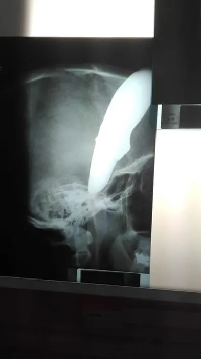 Başına saplanmış 15 cm'lik bıçakla kurtuldu!