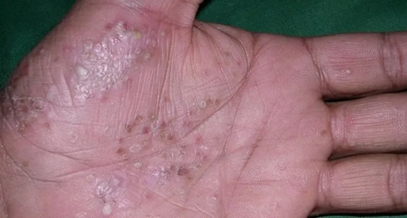 Sedef Hastaligi Nedir Ve Belirtileri Nelerdir Saglik Haberleri