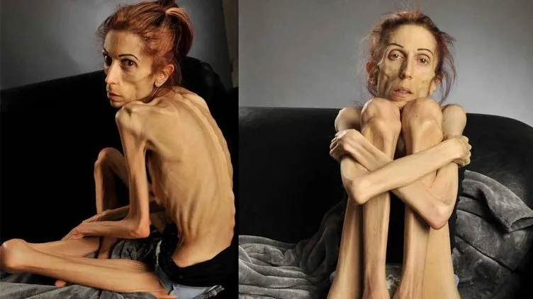 Anoreksiya sonu ölümle bitebilen bir hastalıktır