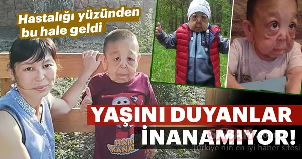 Hastalığı yüzünden bu hale geldi! Yaşını duyanlar inanamıyor