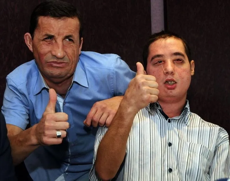 Turan Çolak yeni yüzünü ilk kez gördü Son Dakika Haberler