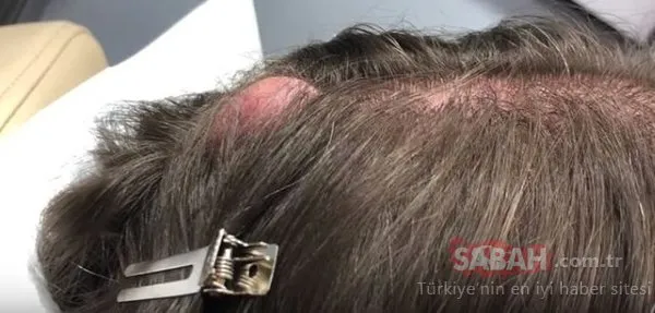 20 yıl bu şekilde yaşadı....Kafasından çıkanlar şoke etti!
