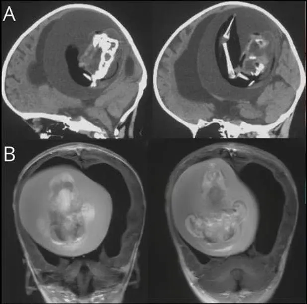 Çin’de akılalmaz olay! İkiz kardeşinin kafatasından çıkarıldı