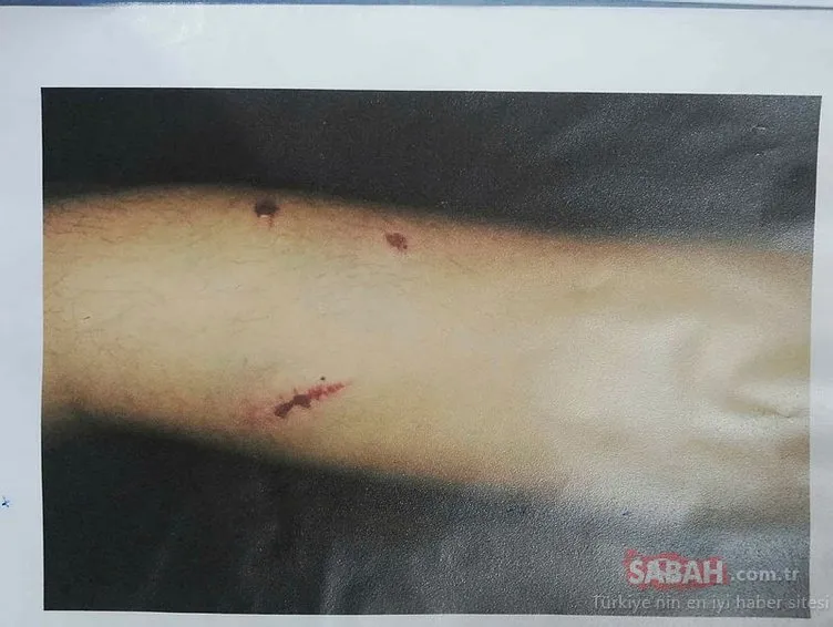 Adana’dan isyan ettiren son dakika haberi: Otizmli genç kızın vücudundaki o görüntü kan dondurdu…