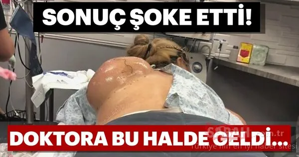 Sırtındaki şişlik şoke etti!
