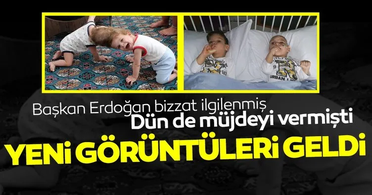 Başkan Erdoğan'ın bizzat ilgilendiği siyam ikizleri yarın geliyor; İşte son halleri