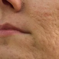 yag bezeleri nasil gecer iste yuzdeki