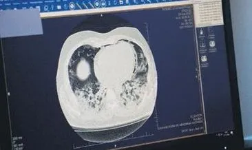 Kovid-19’un akciğerdeki hasarı tomografi görüntülerinde