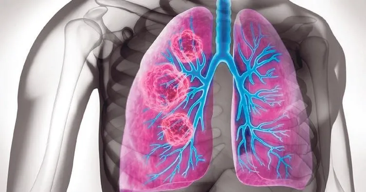 Akciğer kanserinde umut veren gelişme