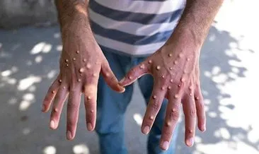 Hindistan’da M çiçeği alarmı