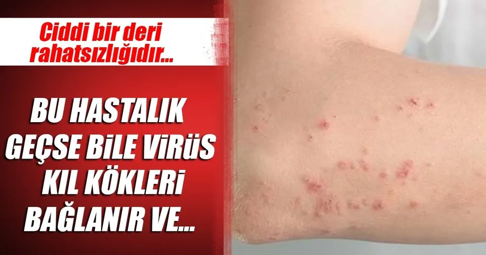 Depresyon Zona Hastaligina Neden Oluyor Saglik Haberleri