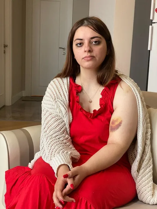 Arkadaşıyla plan yapıp eski nişanlısını ısırdı! İstanbul’da şaşkına çeviren olay