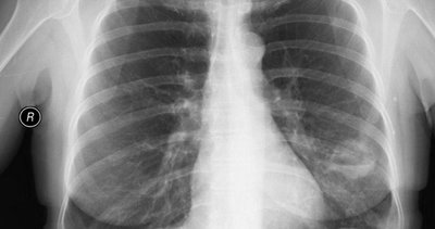 Akciğer kisti nedir, belirtileri nelerdir? Akciğer kisti Kist Hidatik tedavisi nasıl yapılır?