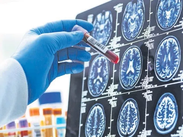alzheimerda-kan-testleri-donemi-1790006378443.jpeg