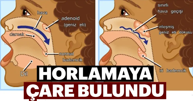 Horlamaya çare boğaz ameliyatı