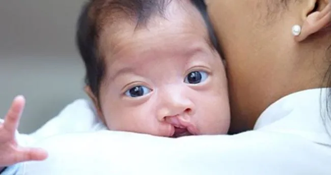 nager sendromu nedir belirtileri