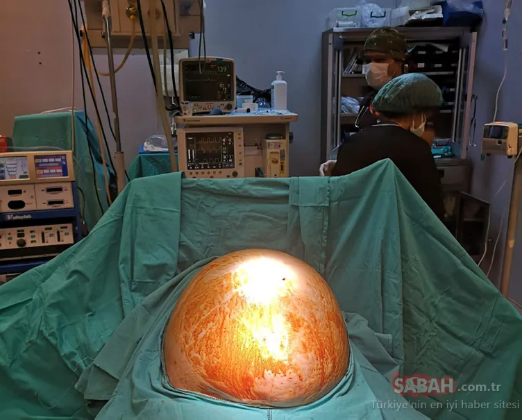 91 kilodan 70 kiloya düştü! Karnından çıkan doktorları şoke etti