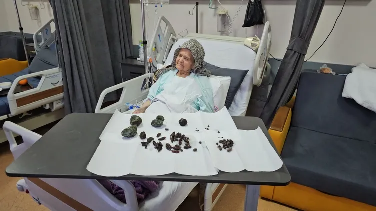 Doktorlar şoke oldu: 92 yaşındaki kadının midesinden ve bağırsaklarından neler çıktı neler!