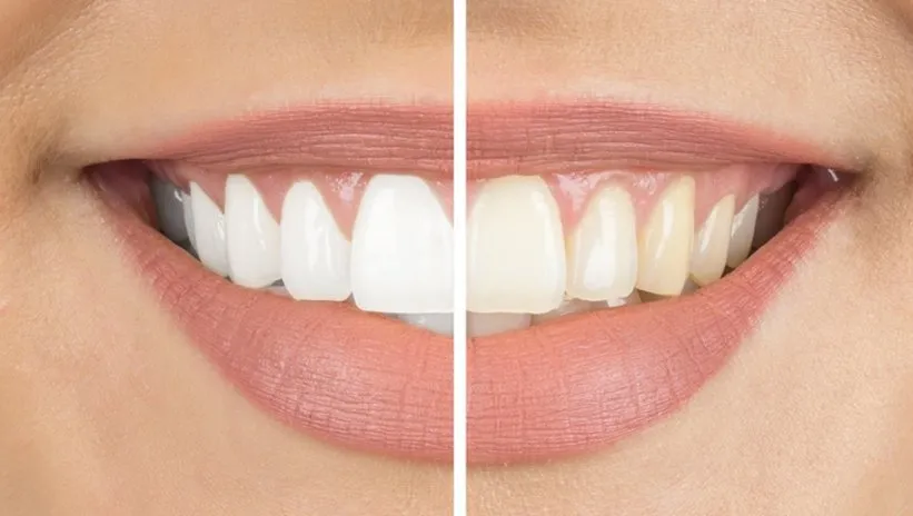 Beyaz diş isterken tüm dişlerinizden olmayın! Uzmanı uyardı: Sakın denemeyin...