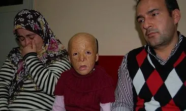 Yeni bir yüz yeni bir hayat! Bebekken yüzü yanan Buse 2 yaşından beri 47 kez ameliyat oldu