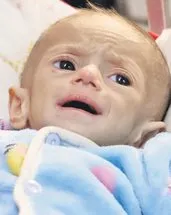 Çocuklar açlıktan gözlerini kaybediyor